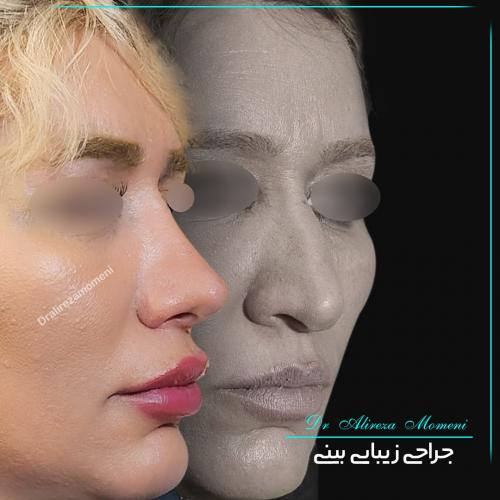 rhinoplasty-481