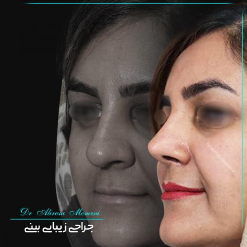 rhinoplasty-482