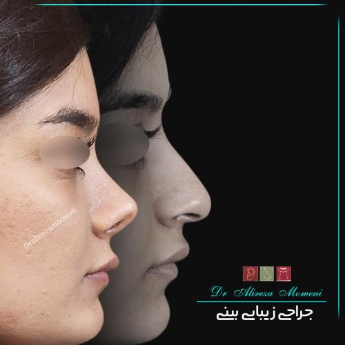 rhinoplasty-483