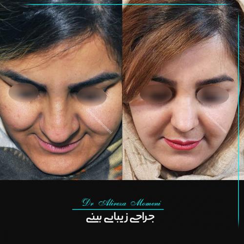 rhinoplasty-484