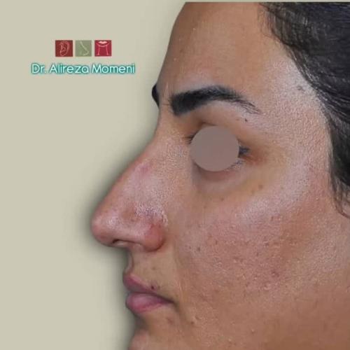 rhinoplasty-485