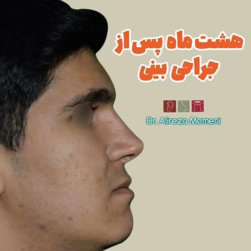 rhinoplasty-486