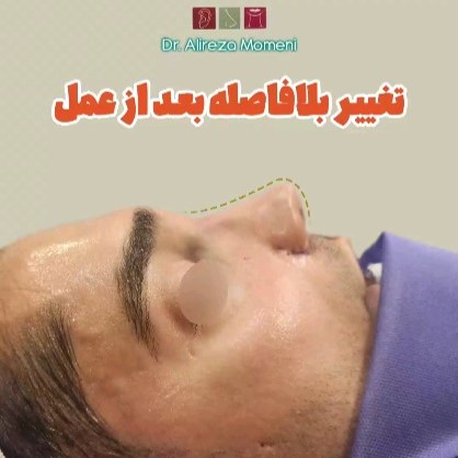 rhinoplasty-487