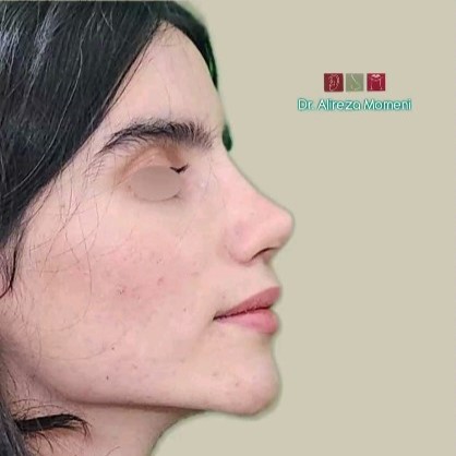rhinoplasty-488