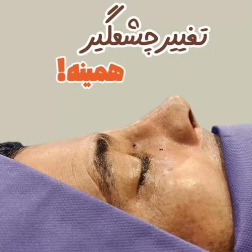 rhinoplasty-489