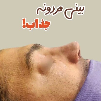 rhinoplasty-491