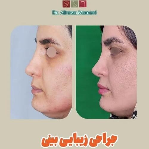rhinoplasty-492