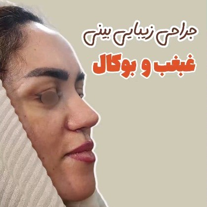 rhinoplasty-493ghabghab