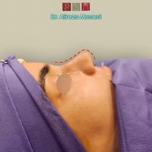 rhinoplasty-494