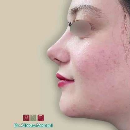 rhinoplasty-495