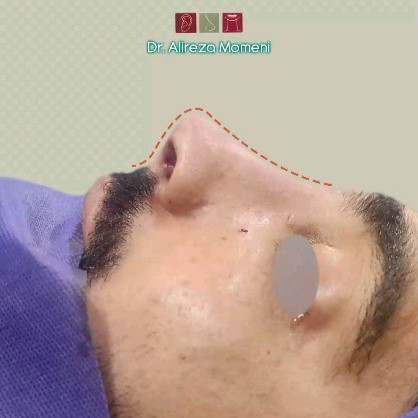 rhinoplasty-496