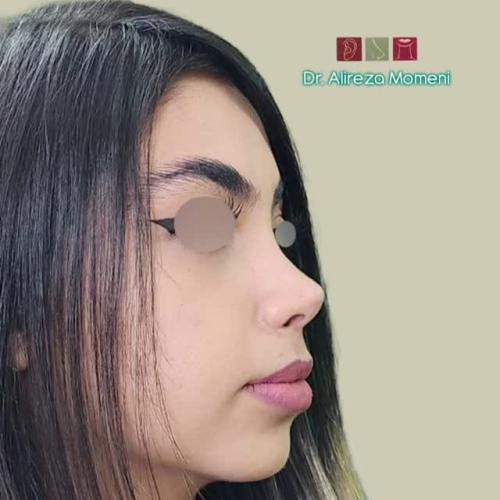 rhinoplasty-497
