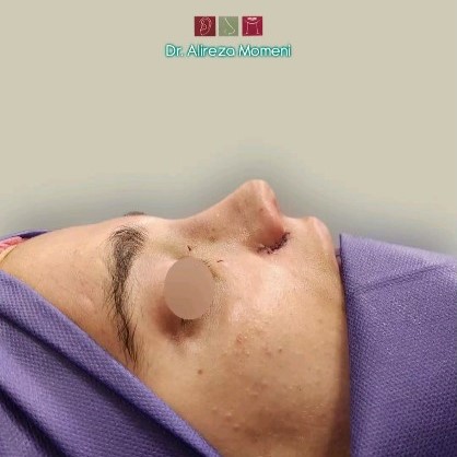 rhinoplasty-498