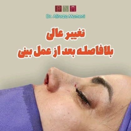 rhinoplasty-499