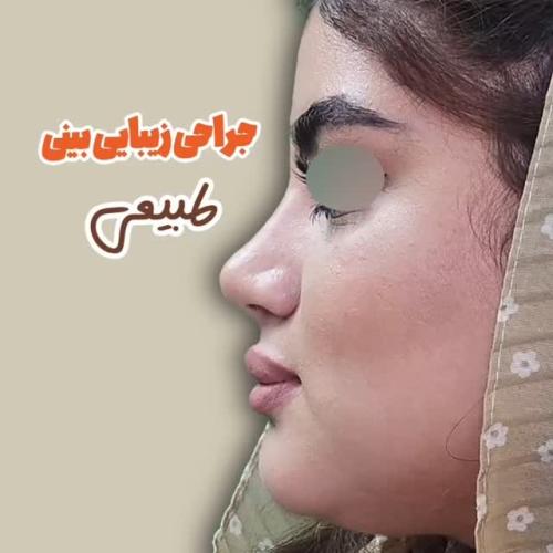 rhinoplasty-500