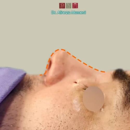 rhinoplasty-501