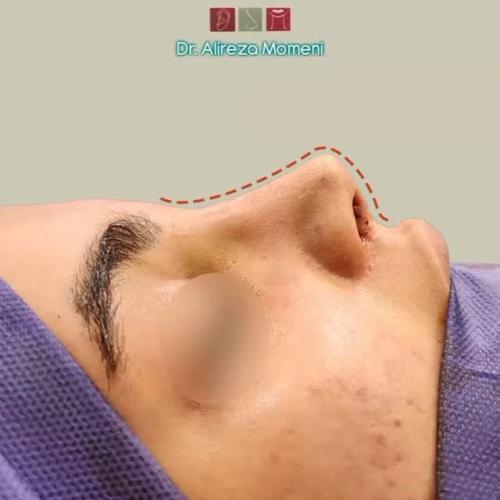 rhinoplasty-502