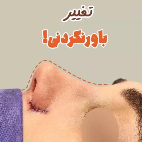rhinoplasty-503