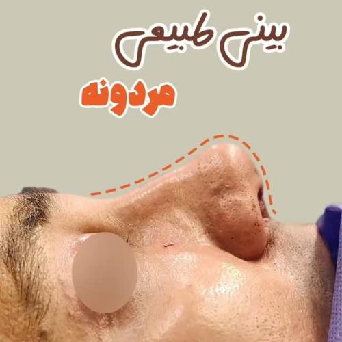 rhinoplasty-504