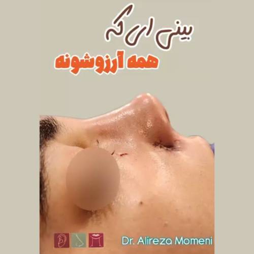 rhinoplasty-505