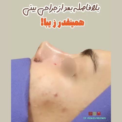 rhinoplasty-506