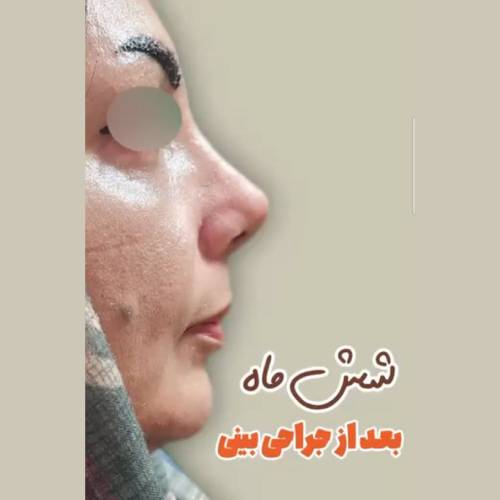 rhinoplasty-507