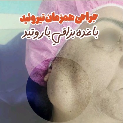 تیروئید-1