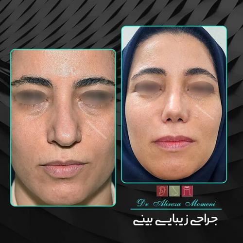 جراحی-بینی-448