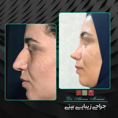 جراحی-بینی-450