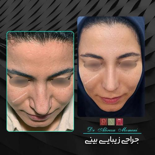 جراحی-بینی-451