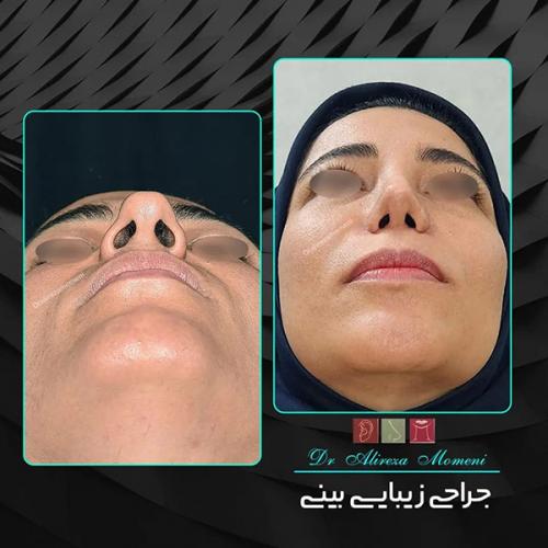 جراحی-بینی-452