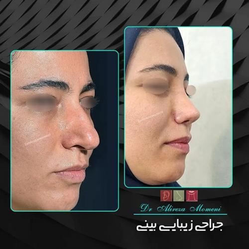 جراحی-بینی-453