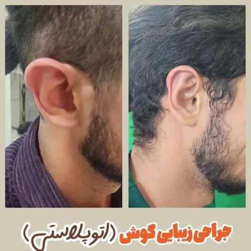 جراحی-گوش-17