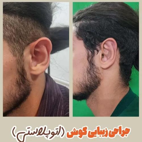 جراحی-گوش-20