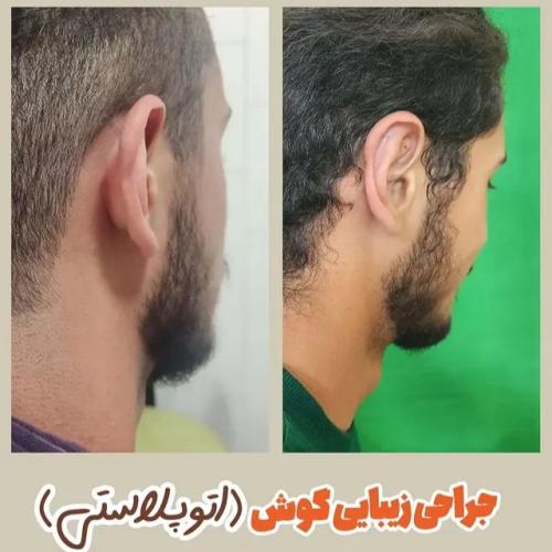 جراحی-گوش-21