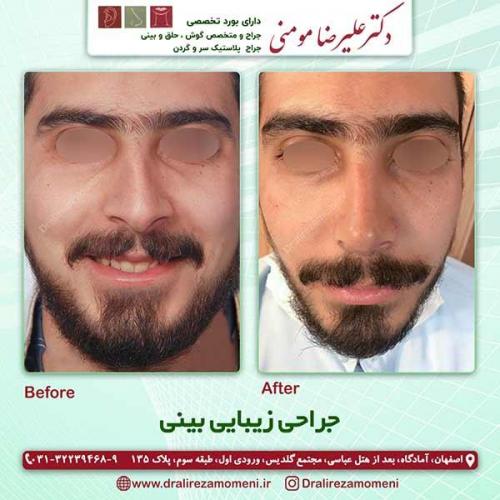 جراحی-بینی-1