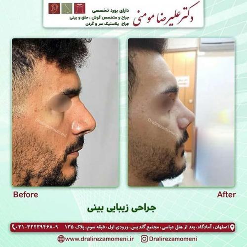جراحی-بینی-100