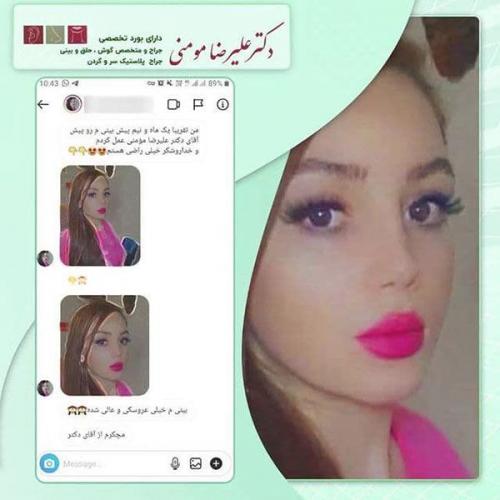 جراحی-بینی-106