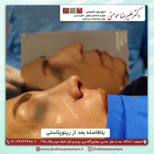 جراحی-بینی-107