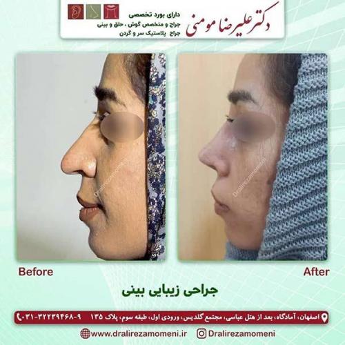 جراحی-بینی-109