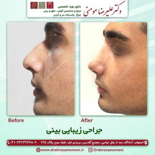 جراحی-بینی-11