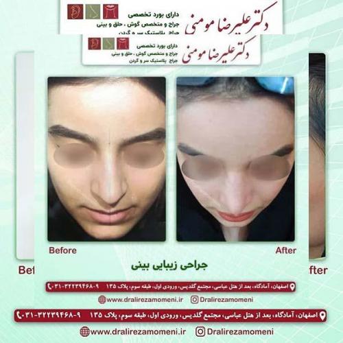 جراحی-بینی-116