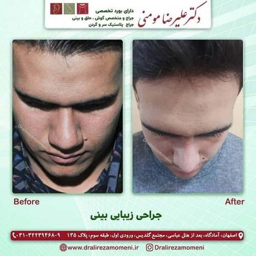 جراحی-بینی-121