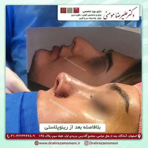 جراحی-بینی-126