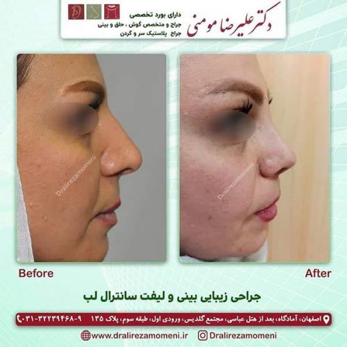 جراحی-بینی-129-و-لیفت-سانترال-لب-2