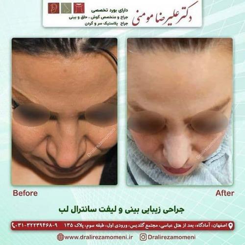 جراحی-بینی-129-و-لیفت-سانترال-لب-4