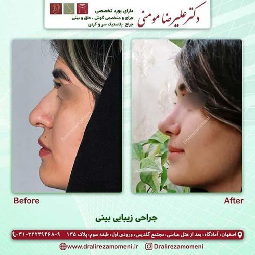 جراحی-بینی-148