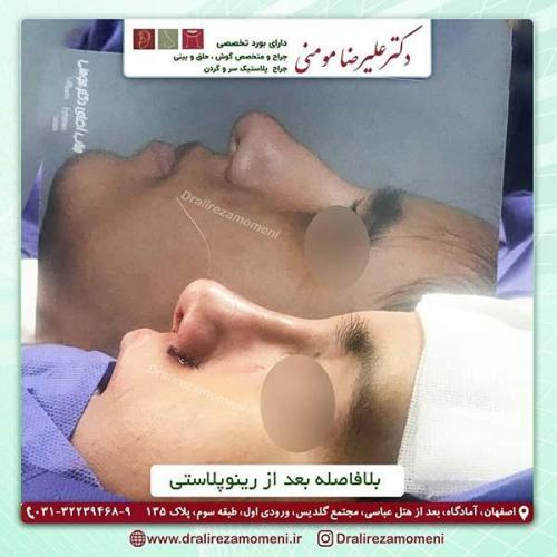 جراحی-بینی-151