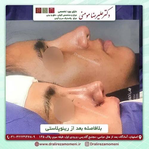 جراحی-بینی-152