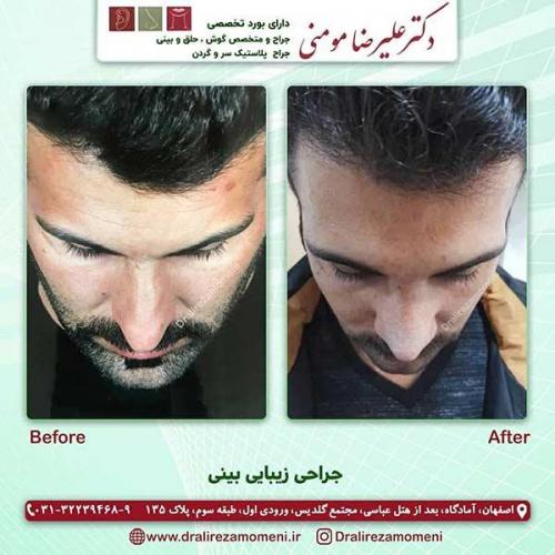 جراحی-بینی-170